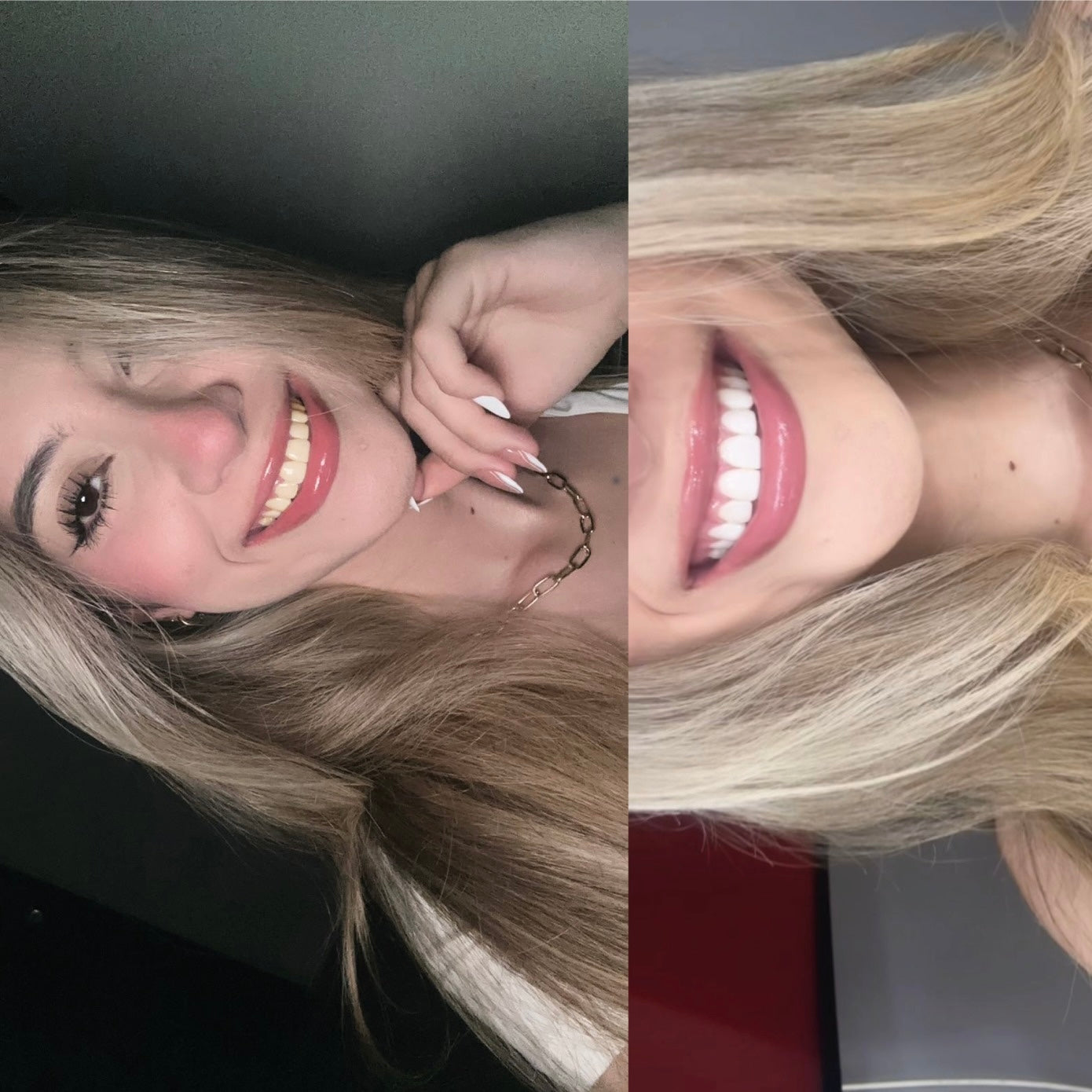 Blanqueamiento Dental