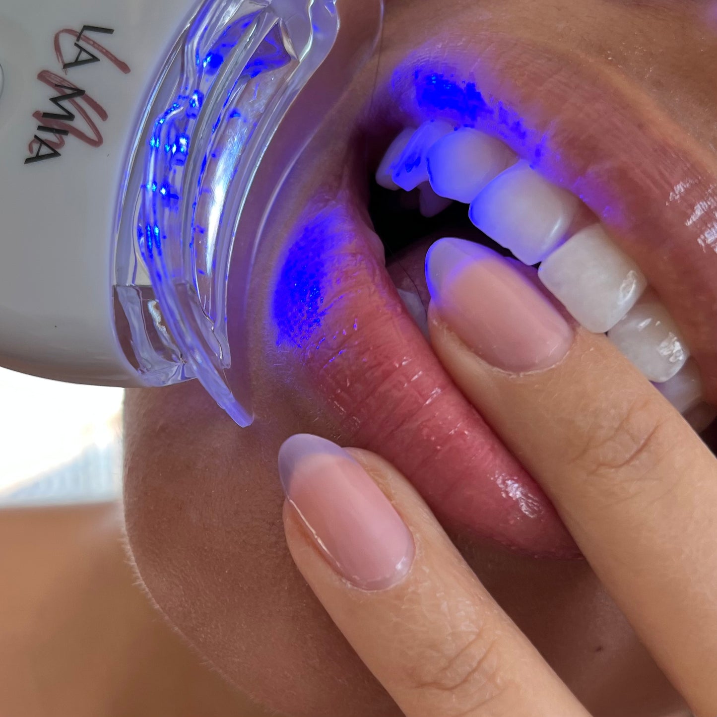 Blanqueamiento Dental