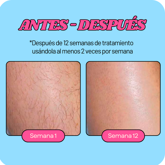 Depiladora Láser en casa
