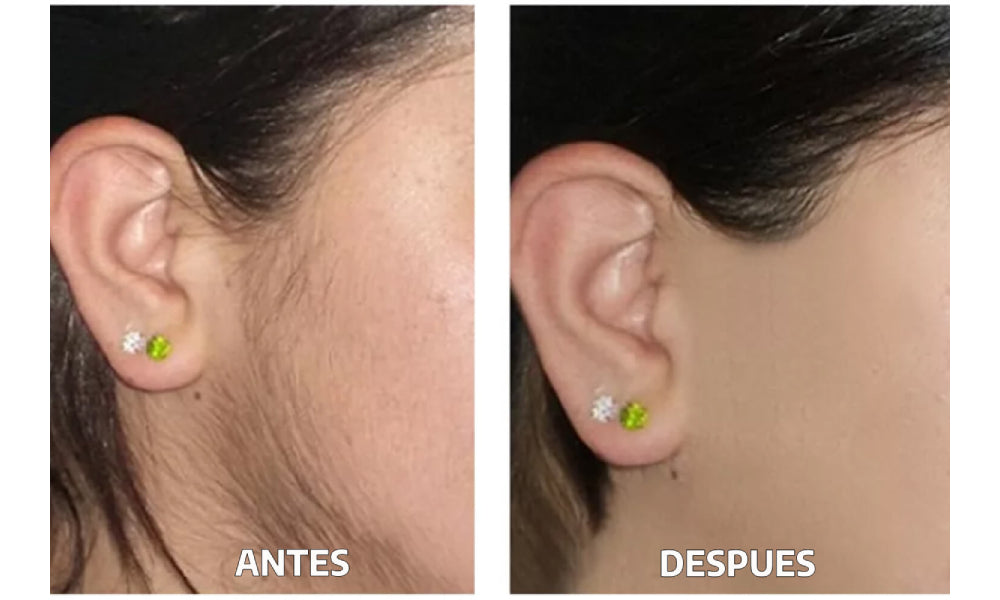 depilación ipl antes y después